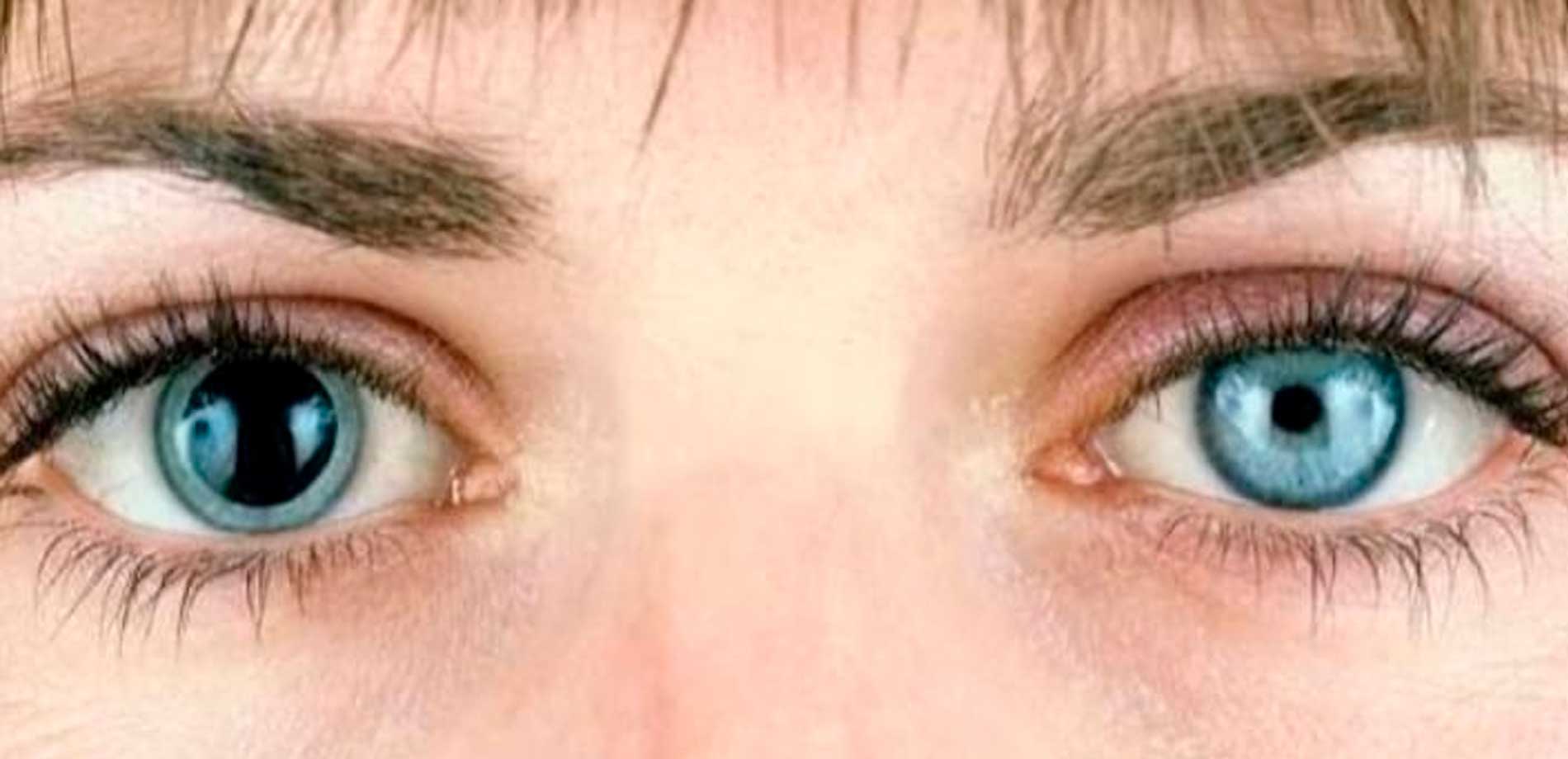 Simetria das pupilas e o diagnóstico de doenças oculares - IOA