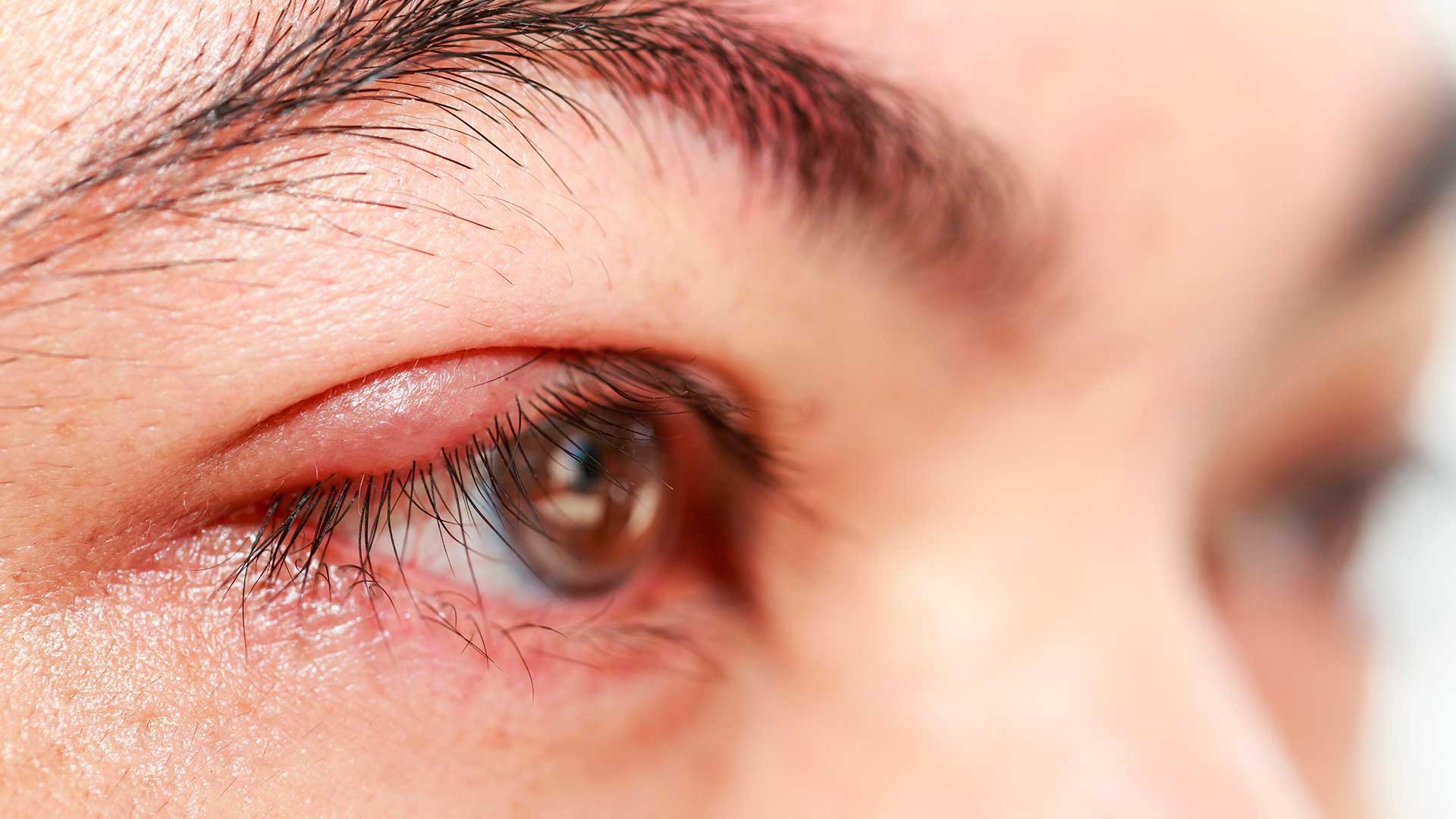 Saiba o que causa e como evitar o incha&ccedil;o das p&aacute;lpebras - IOA Instituto dos  Olhos da Amaz&ocirc;nia