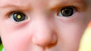 Retinoblastoma: o câncer do olho