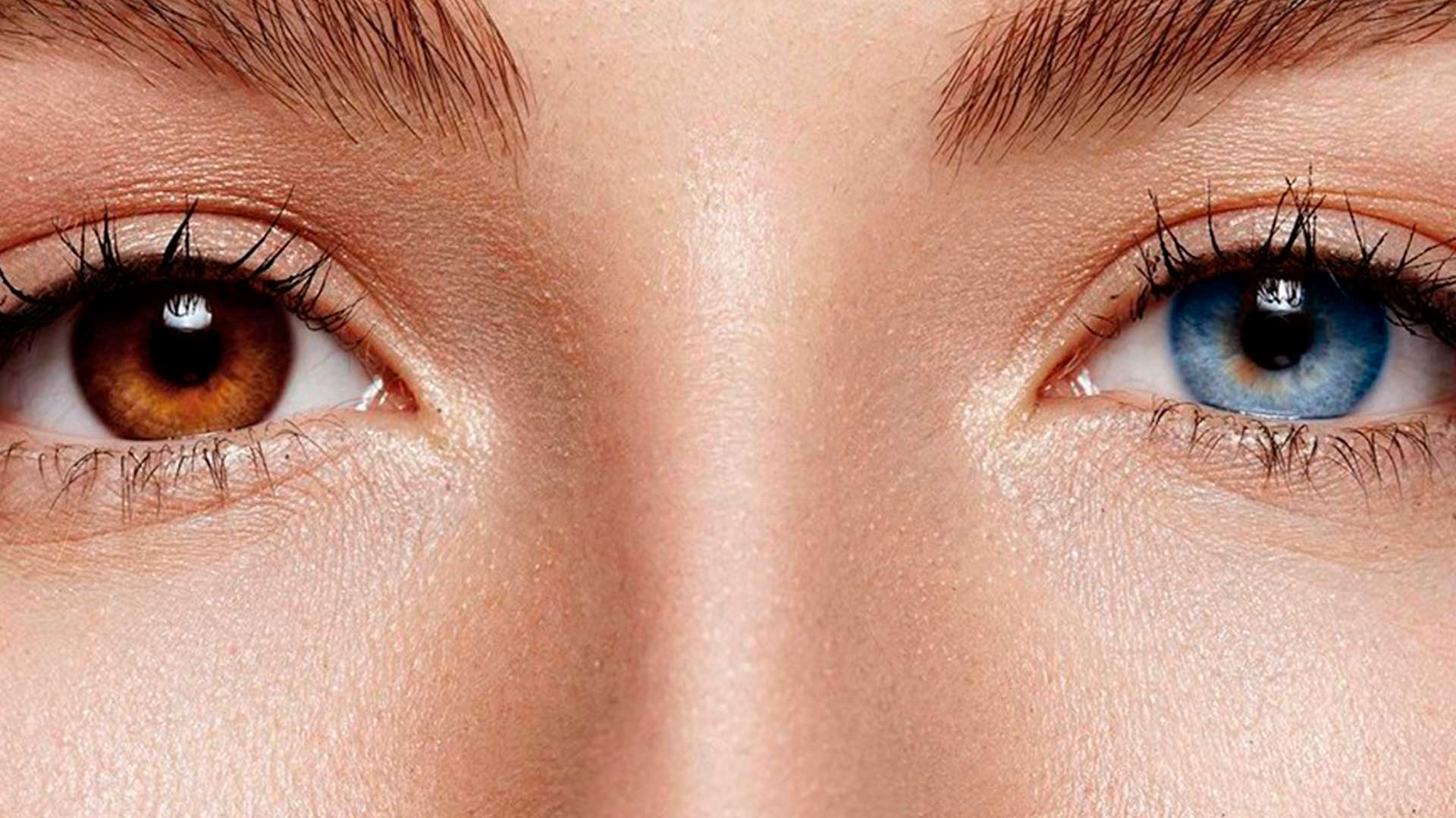 Você conhece a heterocromia ocular?