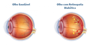 O que é retinopatia diabética proliferativa?
