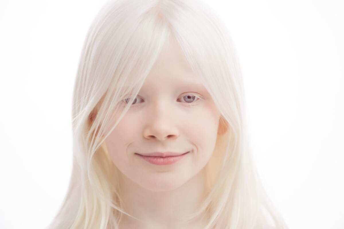 1 --Albinismo-e-os-problemas-visuais