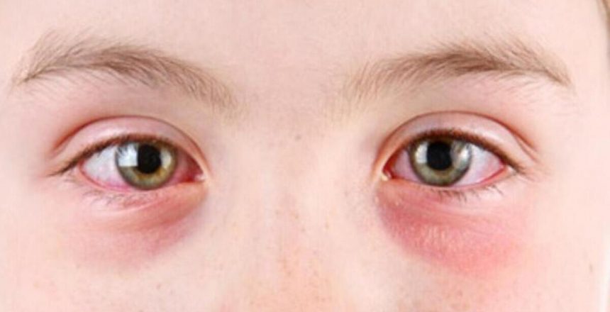 Eczema ao redor dos olhos: sintomas e tratamento