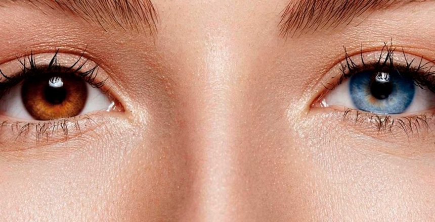 Você conhece a heterocromia ocular?